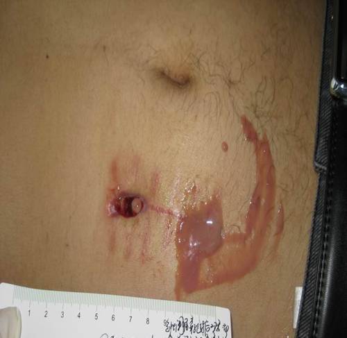 腹腔镜伤口感染的图片图片