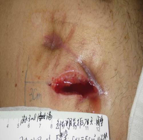 腹腔镜伤口感染的图片图片