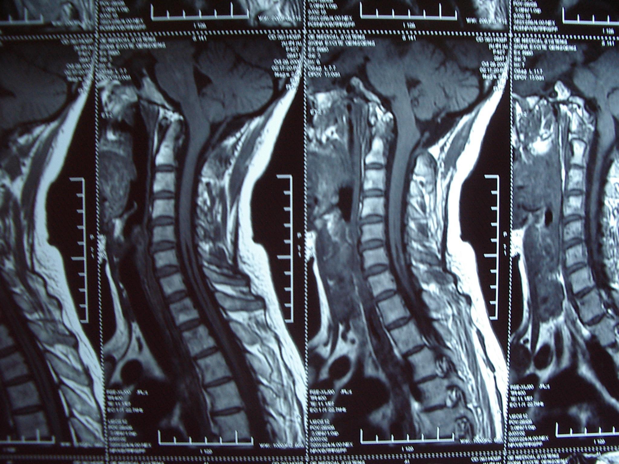 referring to the posterior fossa craniectomy and tonsillar re
