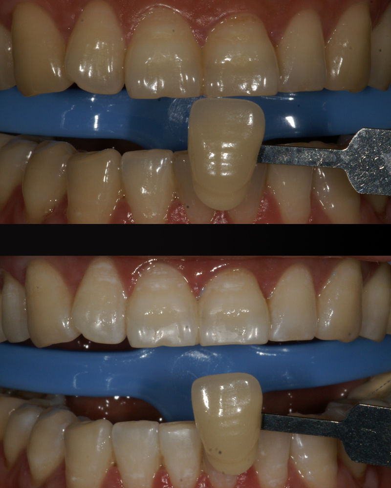 普通"黄牙"冷光美白