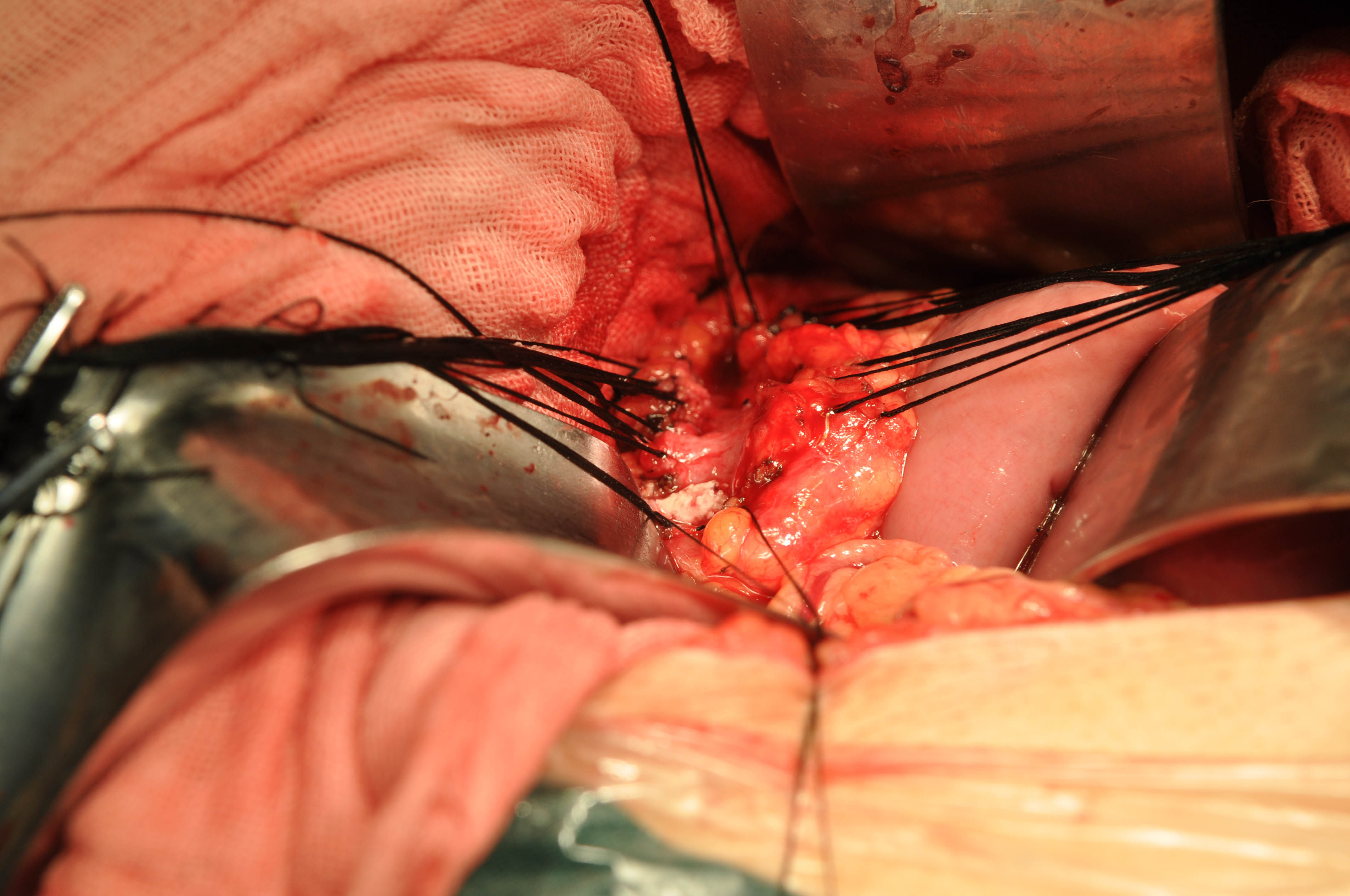 胰管结石:取尽结石后行胰肠吻合较好,但有时需切除胰头或胰体尾才有更