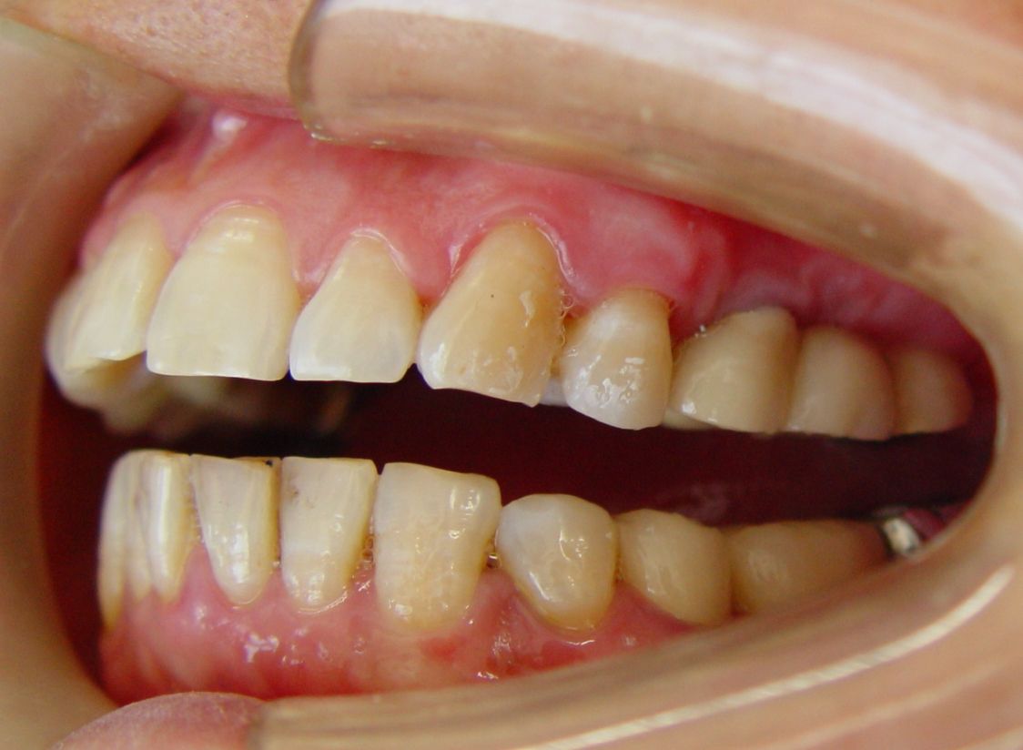 后牙种植固定义齿 - 好大夫在线