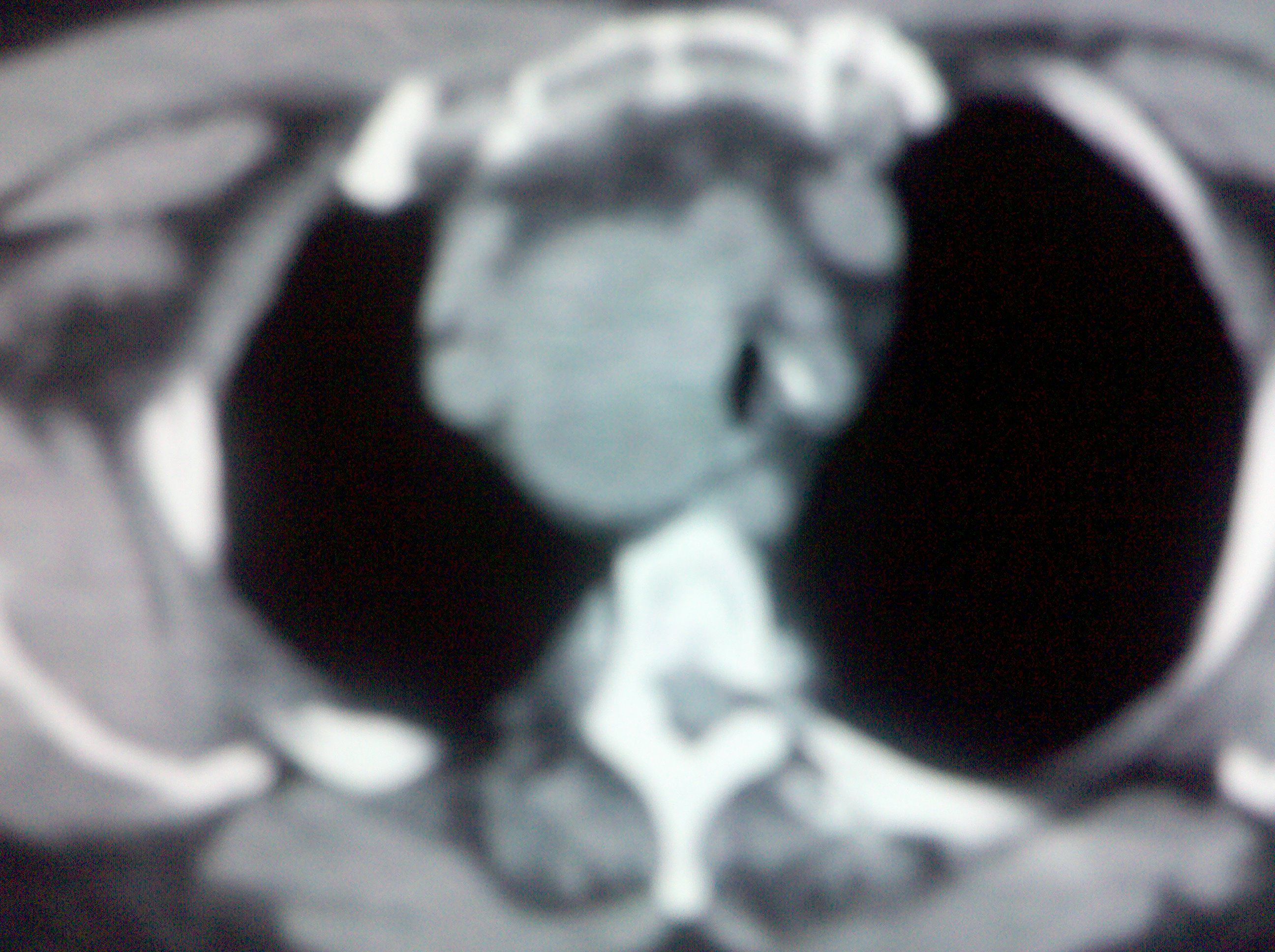 胸壁肿瘤的CT诊断 - 知乎