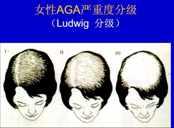 转载:中国雄激素性脱发专家诊疗共识(2009版,