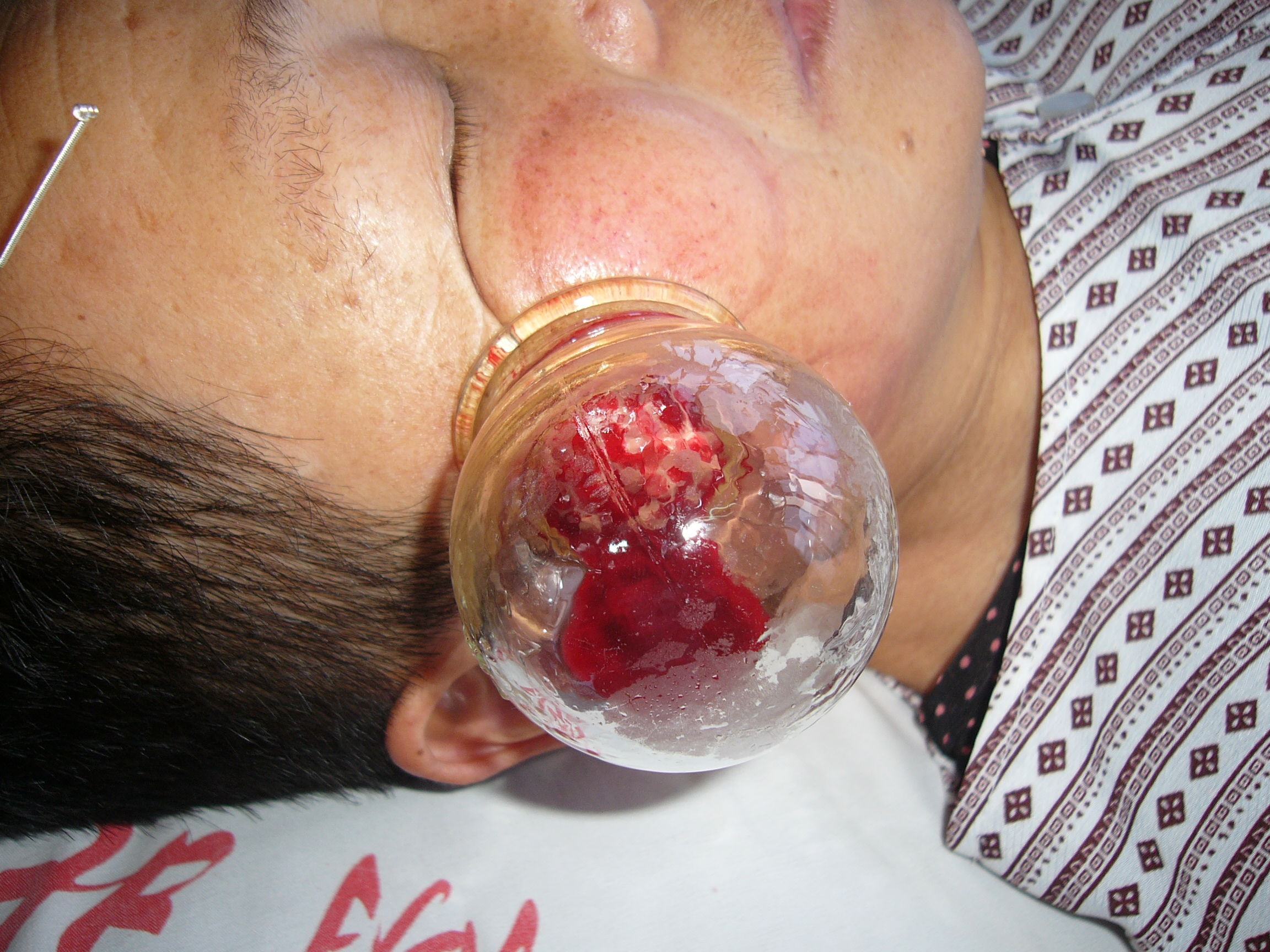 三棱针刺血疗法在疑难杂症症的临床应用