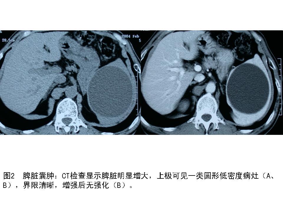 脾臟腫瘤