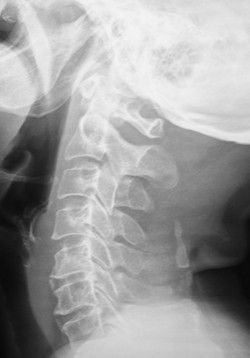 颈椎X线拍片报告上的颈椎生理曲度变直是什