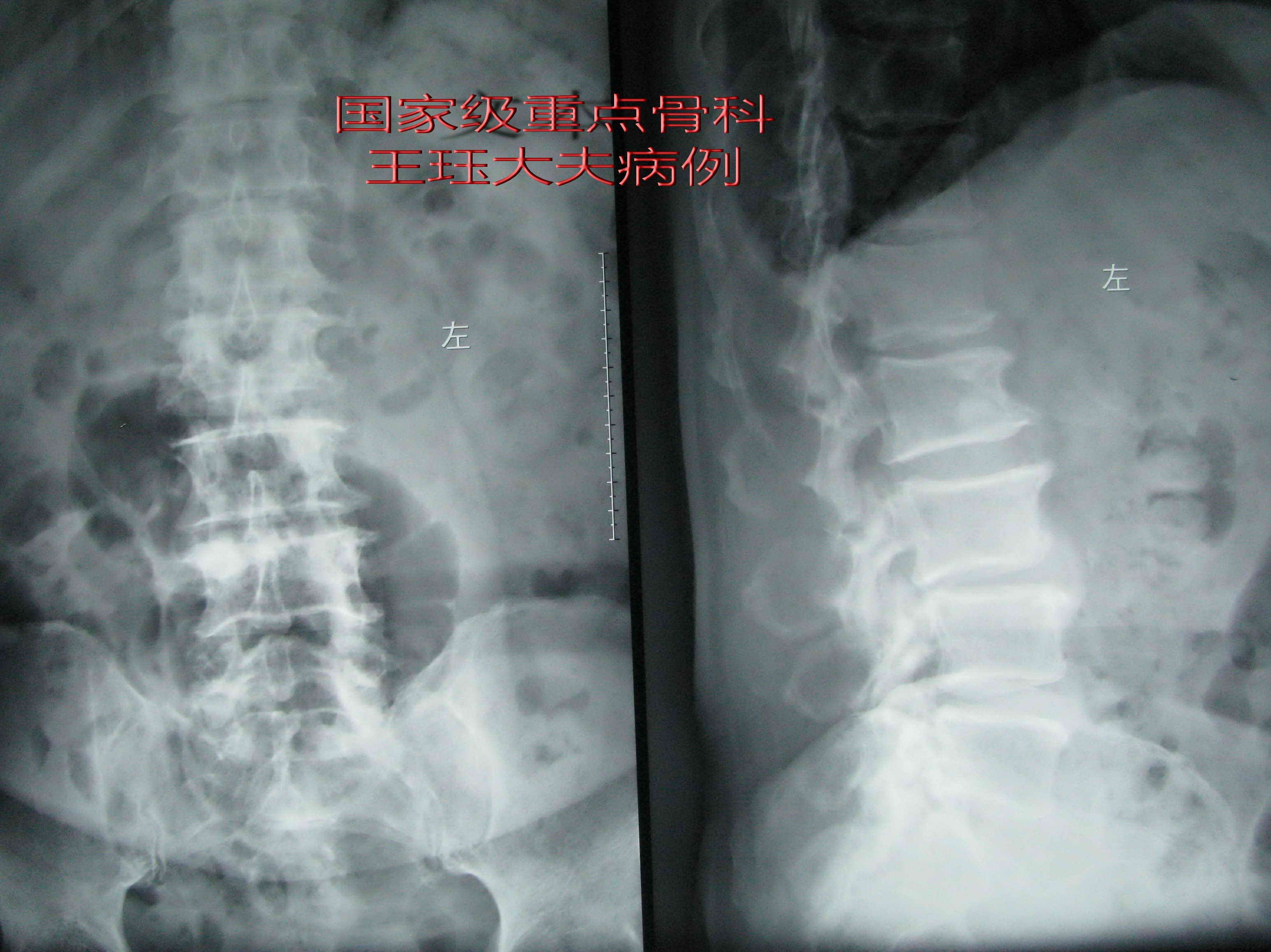 病例2 男 81岁 双下肢强迫屈曲位不能行走 热爱生活