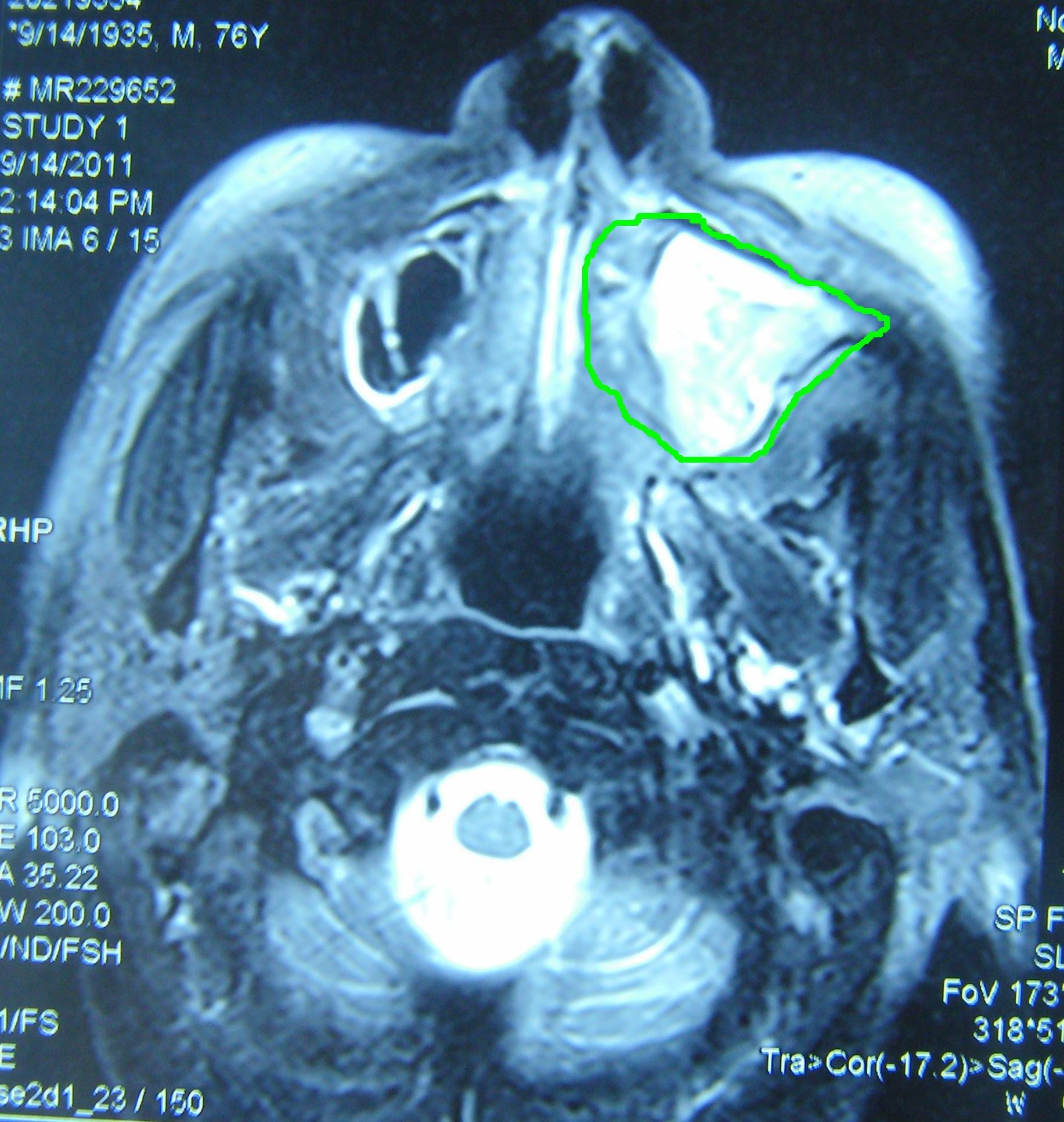 上颌窦肿瘤图片