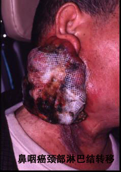 鼻咽癌的表现
