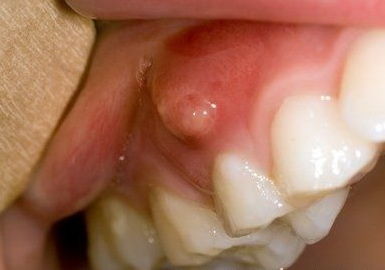 春节快到了,节日期间怎样避免牙痛