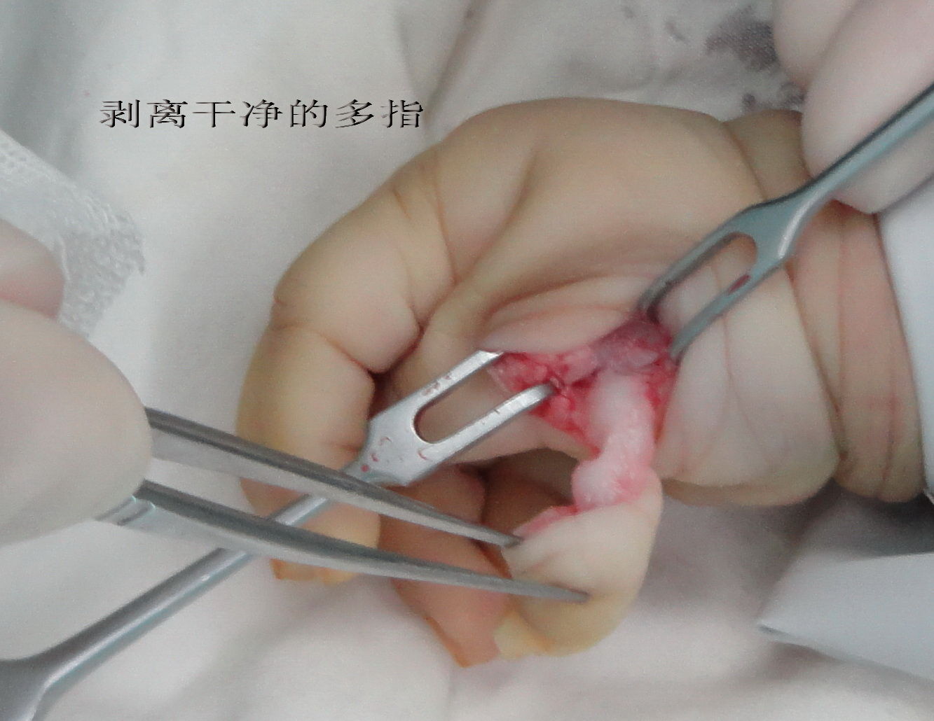 小婴儿多指切除术全过程