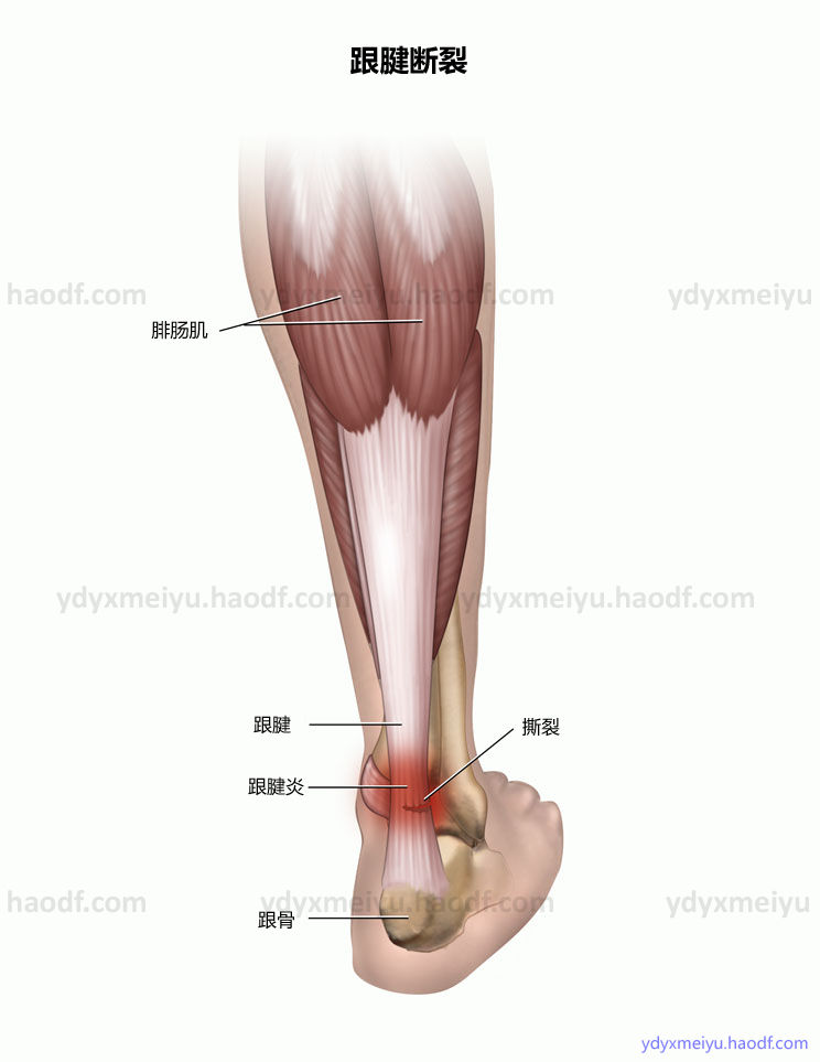 At 跟腱断裂 跟腱炎 跟腱腱围炎 末端病康复练习法 Ydyxmeiyu Haodf Com 跟腱断裂 跟腱断裂康复 好大夫在线