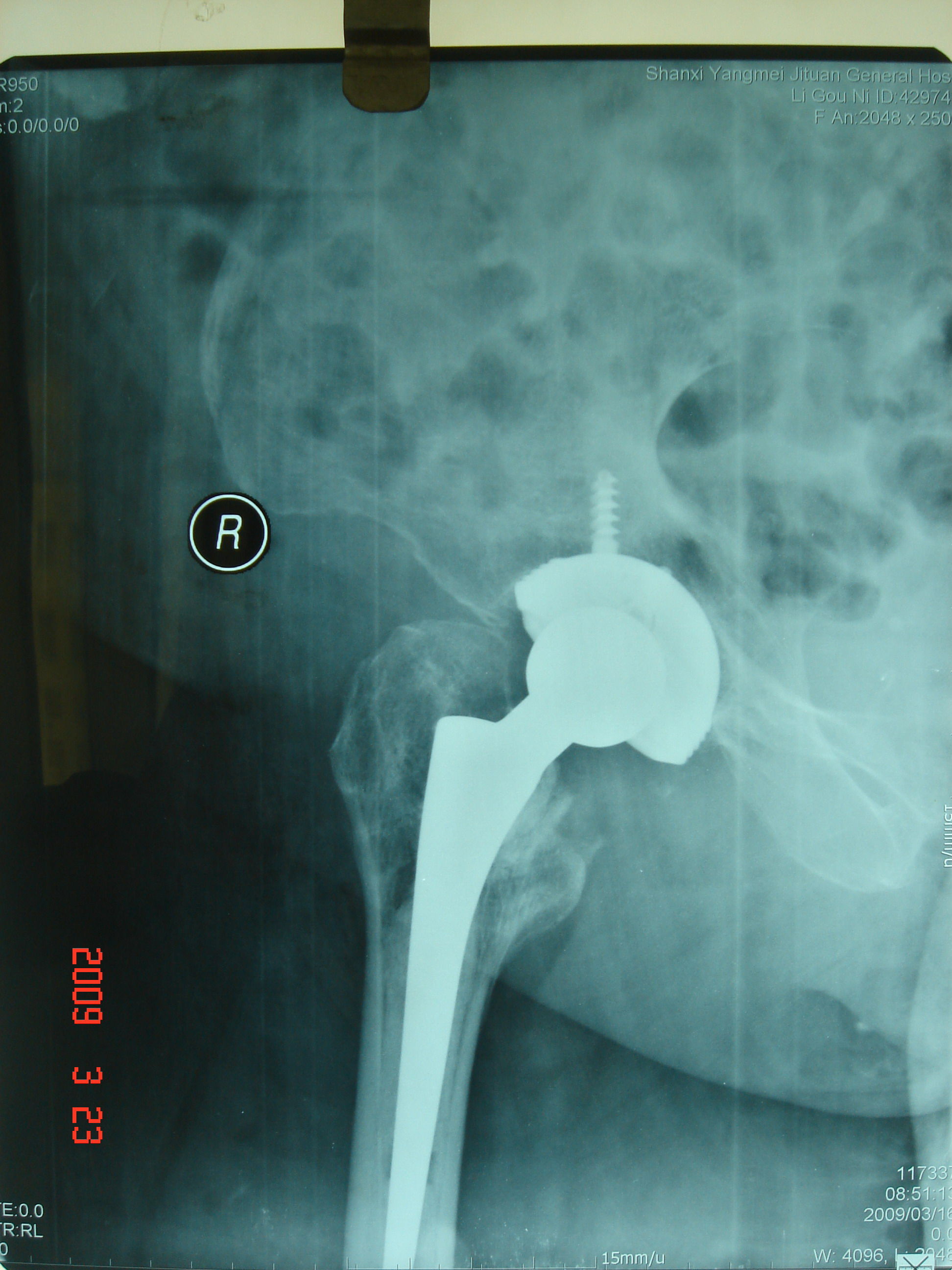 股骨粗隆间骨折的手术治疗