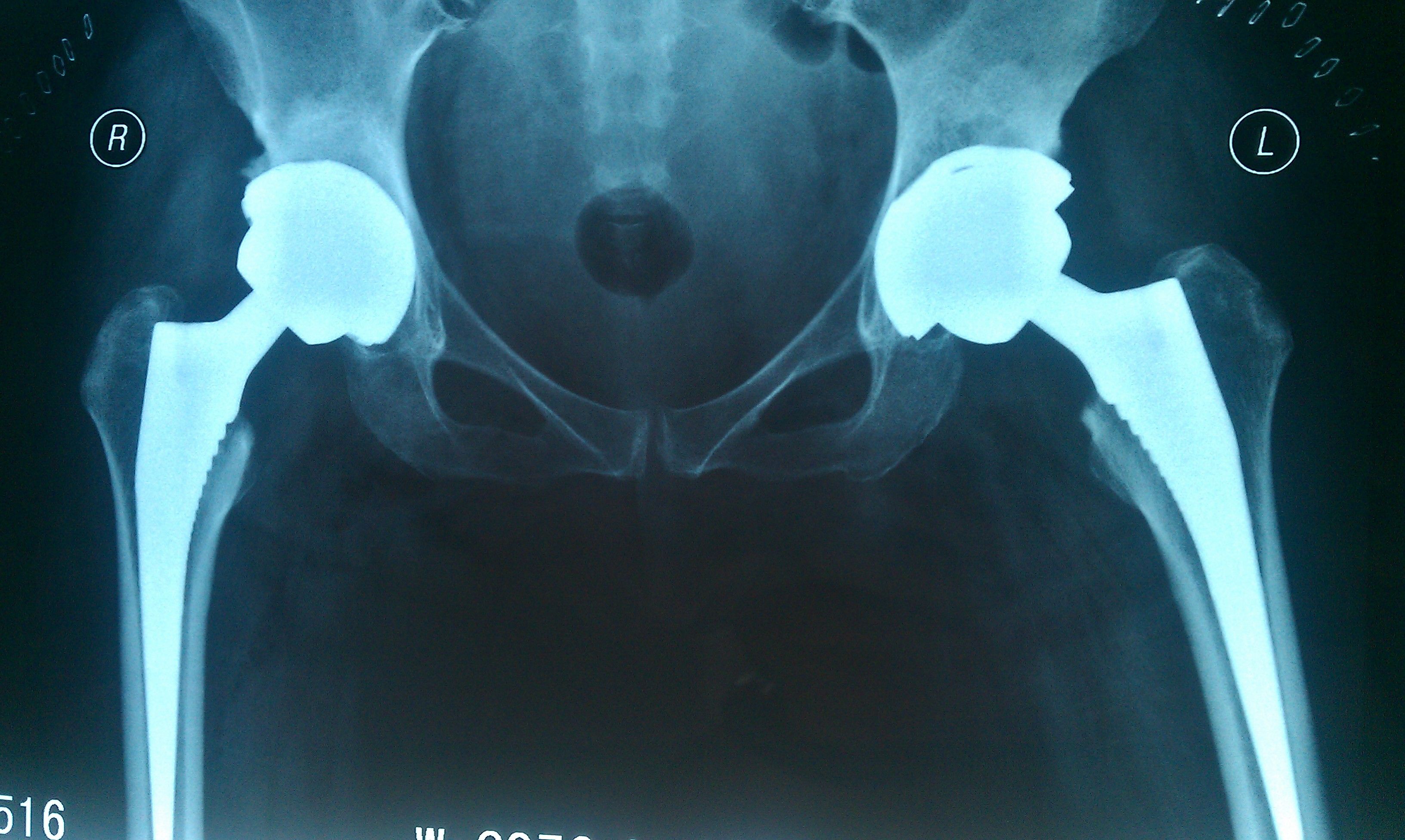 一边股骨痛是什么原因（造成股骨头坏死疼痛的原因有哪些？股骨头坏死患者应该注意什么？） | 说明书网