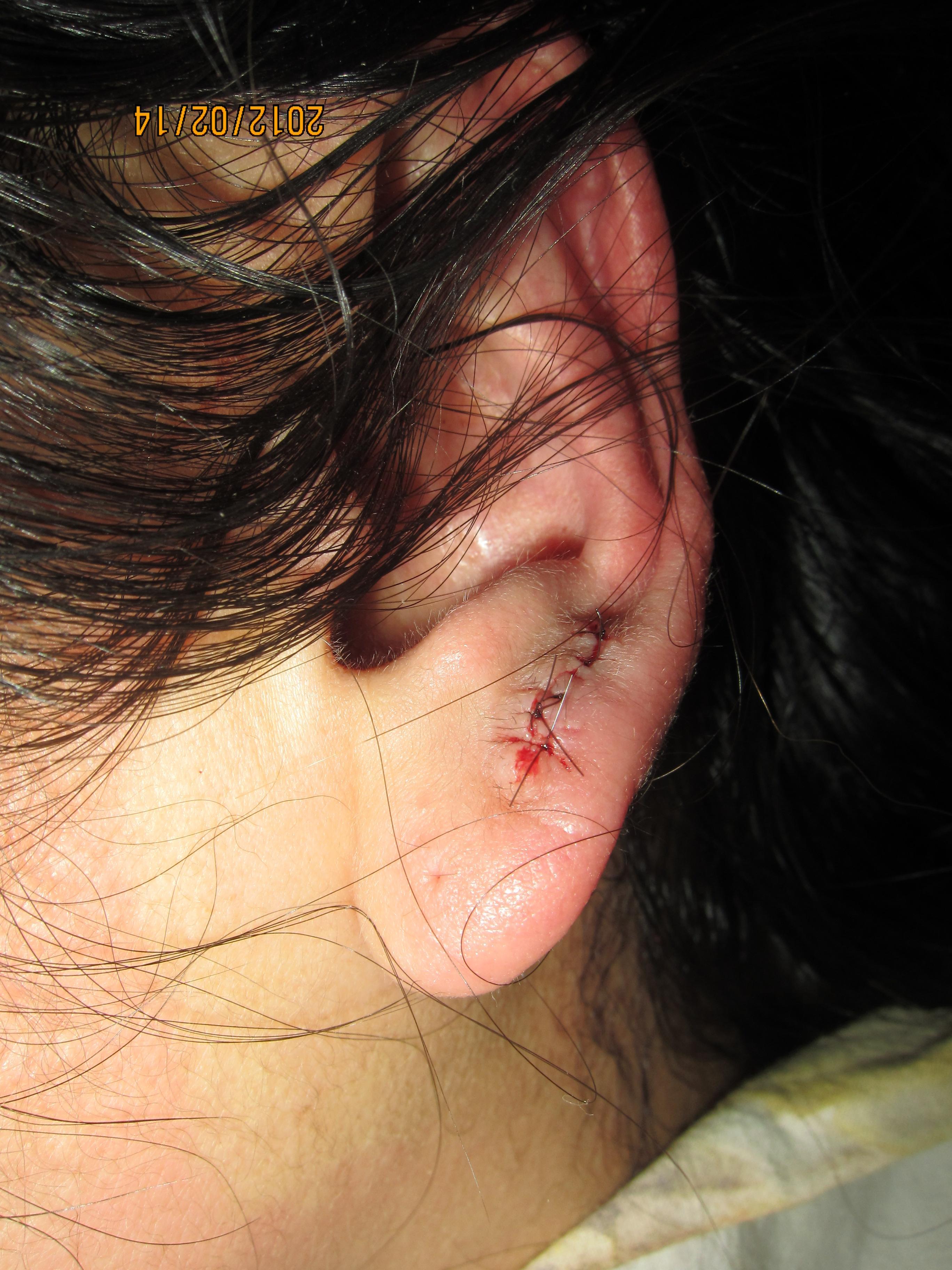 耳朵瘢痕疙瘩耳洞图片
