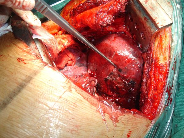 照片巨大右肺上沟癌切除