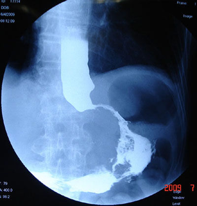 贲门癌晚期胃镜图片图片