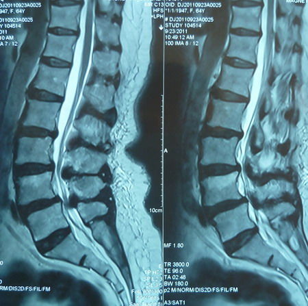 狭窄 脊椎 症 管 脊柱管狭窄症：症状、原因、診断および治療
