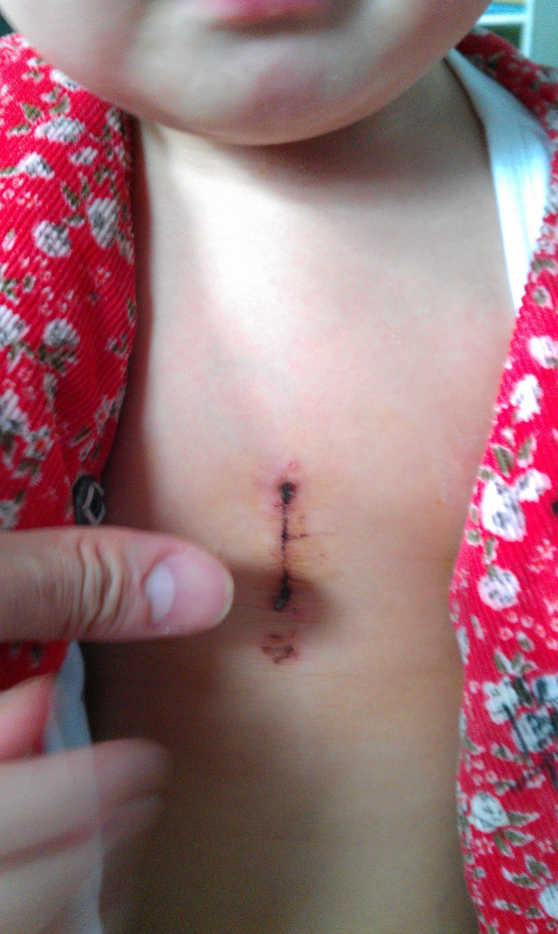 正中小切口的图片