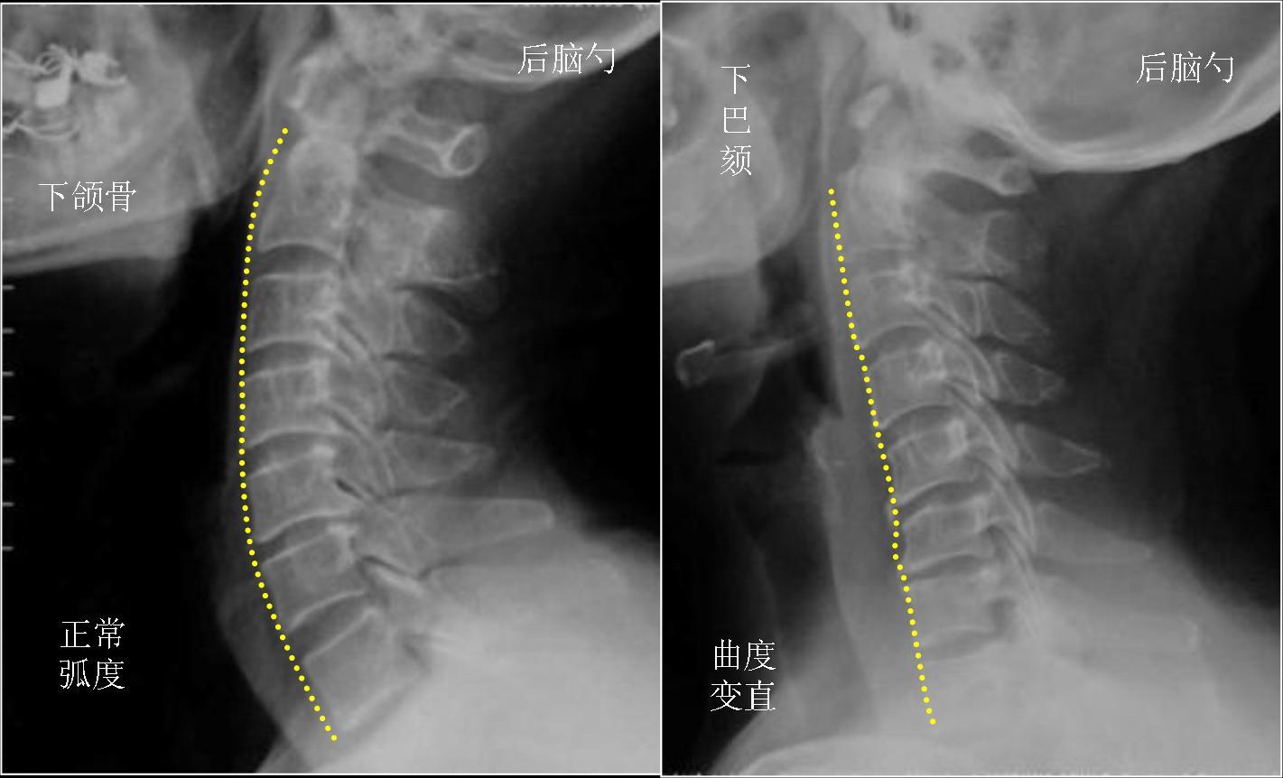 颈椎病引起背痛部位图图片