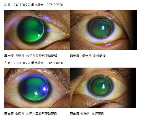 rgp矫正双眼角膜大散光一例