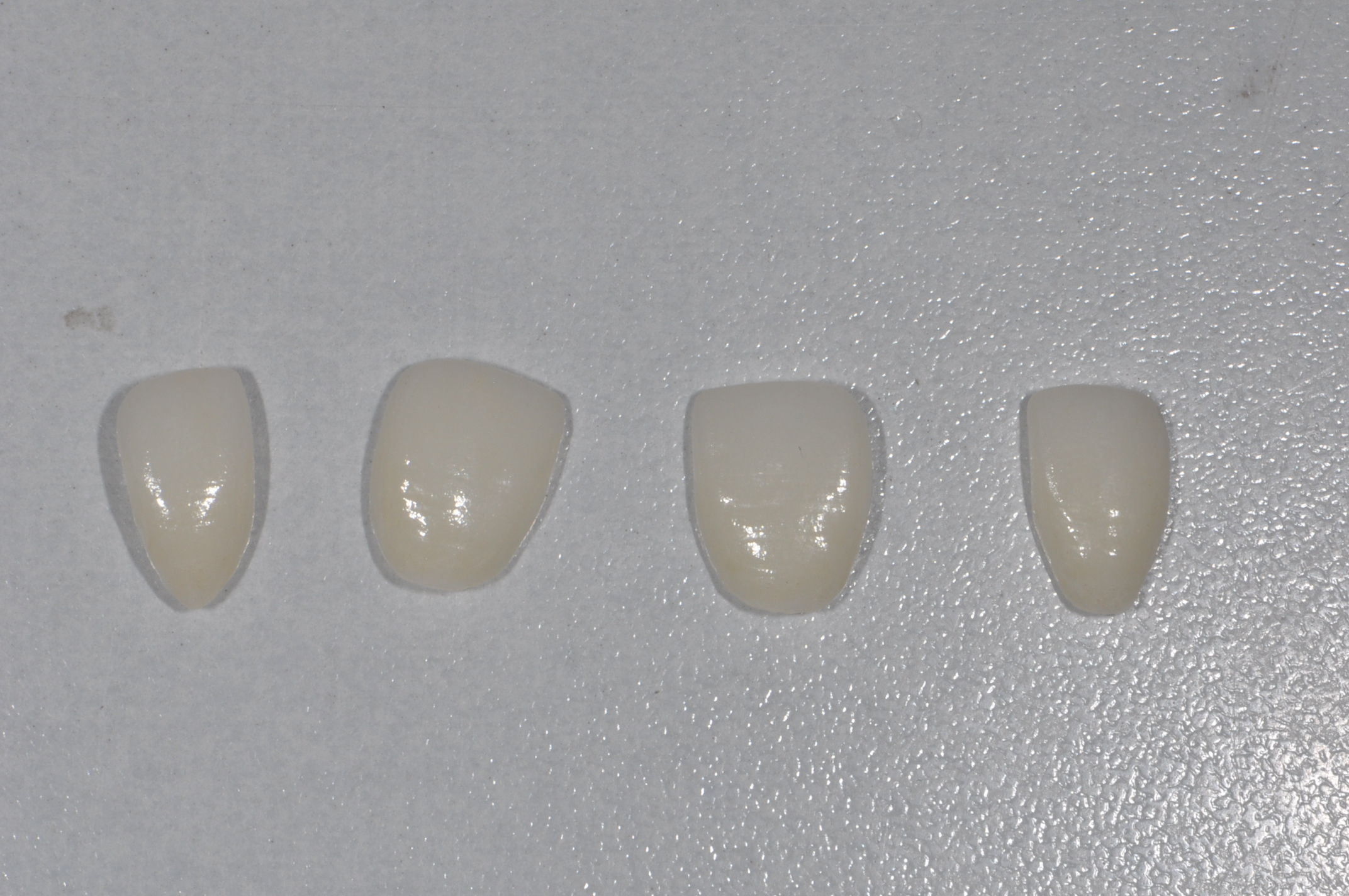 前牙瓷贴面美容修复一例