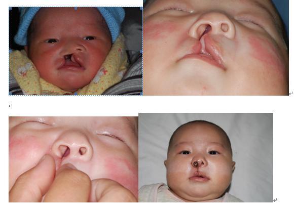 经过我们发明的新生儿唇腭裂非手术矫正塌鼻子