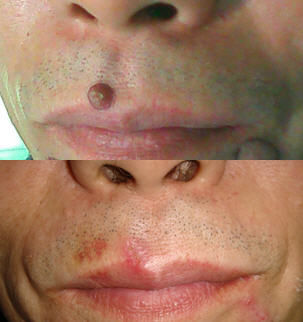 多毛症  4.皮肤松弛,皱纹  5. 疤痕  6. 皮肤赘生物:痣,疣等 1.