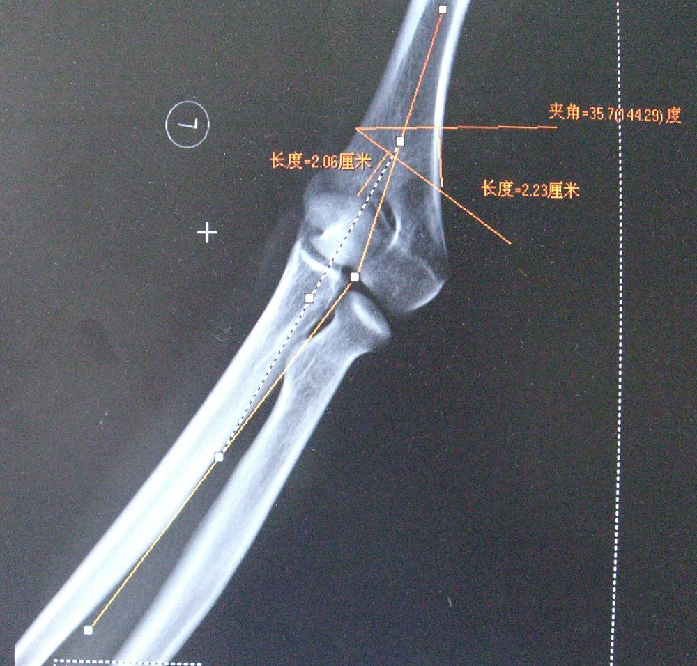 肘內翻病例分享