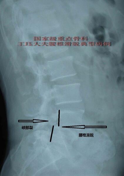 病例5男47歲腰椎滑脫症腰椎間盤突出合併腰椎管狹窄症病例腰腿再也不