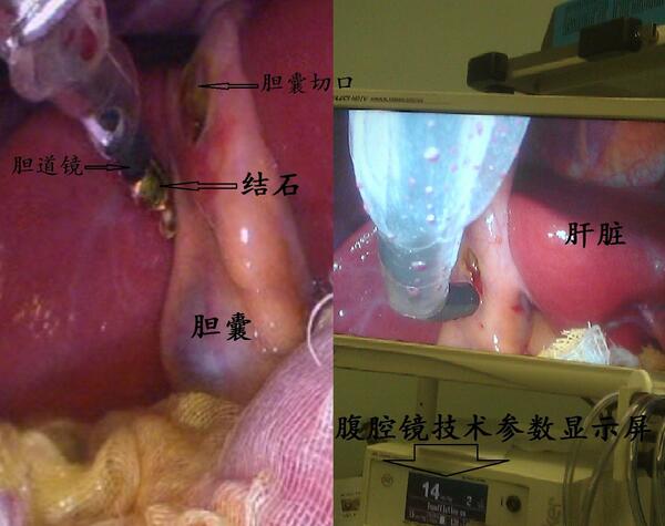 腹腔镜下保留胆囊取出结石一例