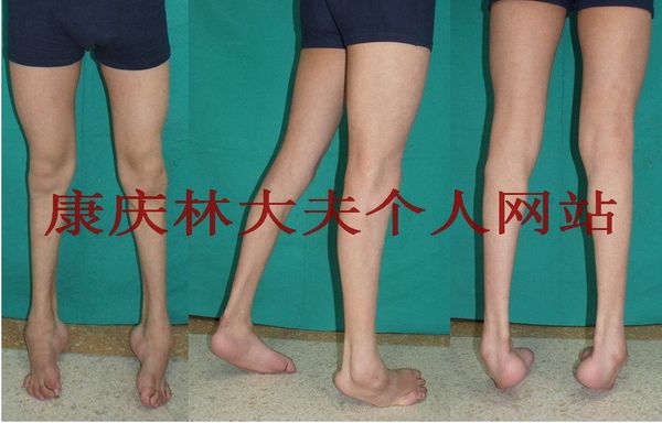 足跟不着地并内翻,前足内翻内收,趾间关节屈曲,跖趾关节过伸,跟腱挛缩