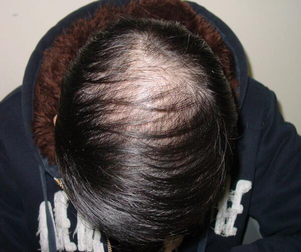 自述,脱发问题已有3~5年之久了,最初头顶头发渐渐稀少时并未引起重视