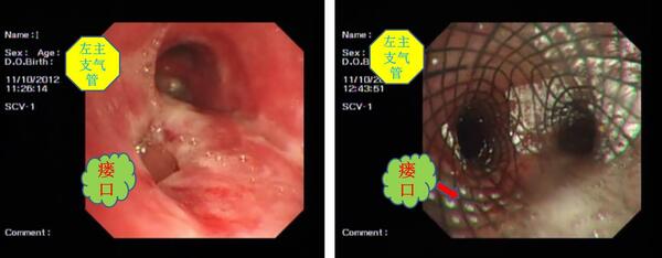 气管食管瘘图片