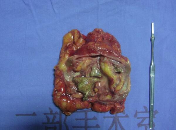 典型病例16-右肾结石伴肾萎缩,无功能肾行腹腔