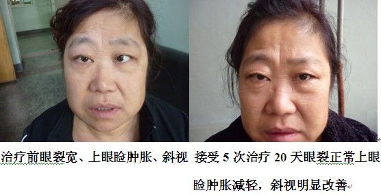 核醫學近距離照射治療甲亢突眼與框外放療有何區別山東青島