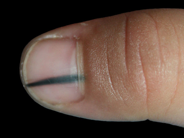 甲黑线-甲下色素痣