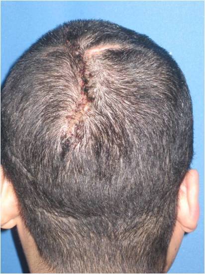 头皮肿物扩张后切除修复