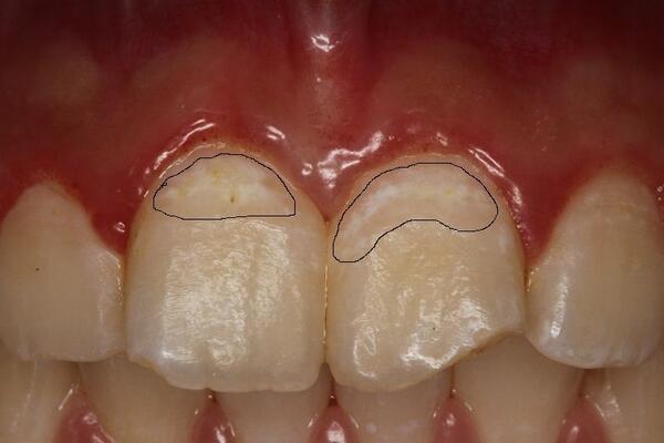 看图说话新解-牙齿表面脱矿形成白班的治疗