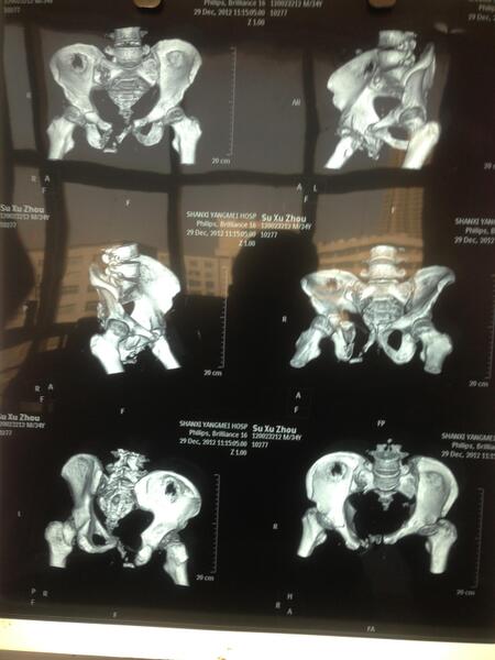 (骨盆骨折tile c型損傷術前ct三維重建片)(骶髂關節經皮螺釘內固定及