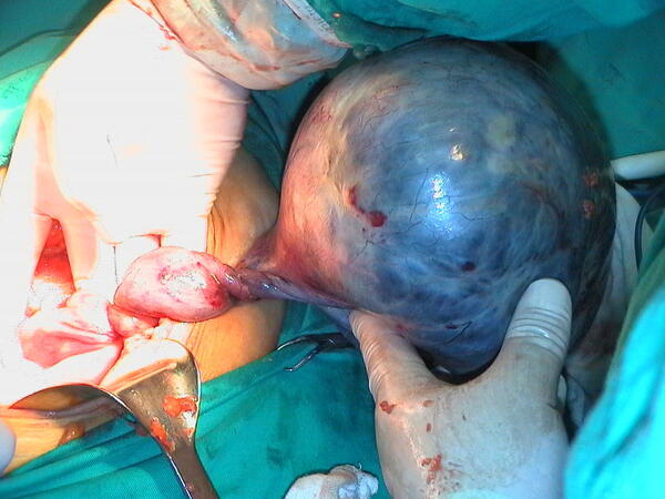 成熟畸胎瘤图片图片
