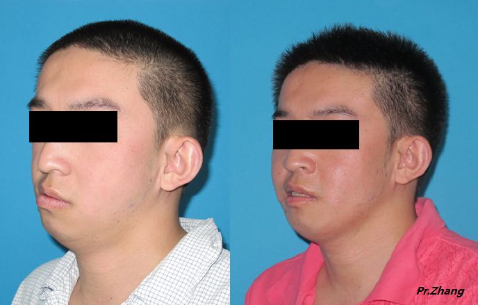 成人第一,二腮弓综合症的综合手术重建 - 好大夫在线