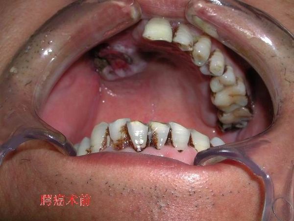 口腔颌面部肿瘤手术治疗及遗留缺损的组织瓣移植修复