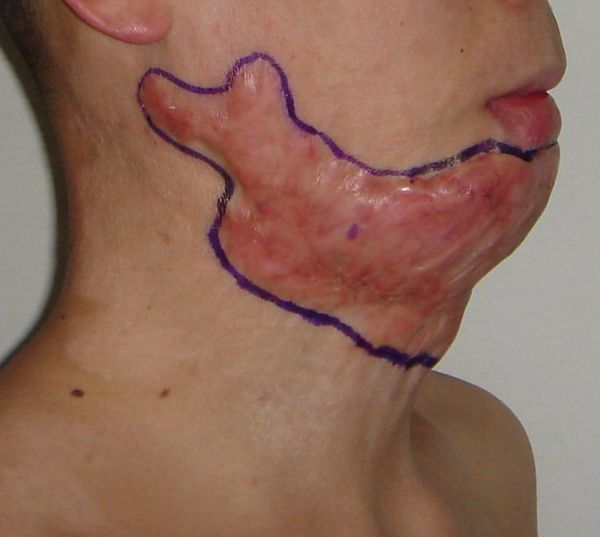 其特点是面颈部疤痕面积大,厚,应用植皮或皮肤扩张等方法,很难取得好