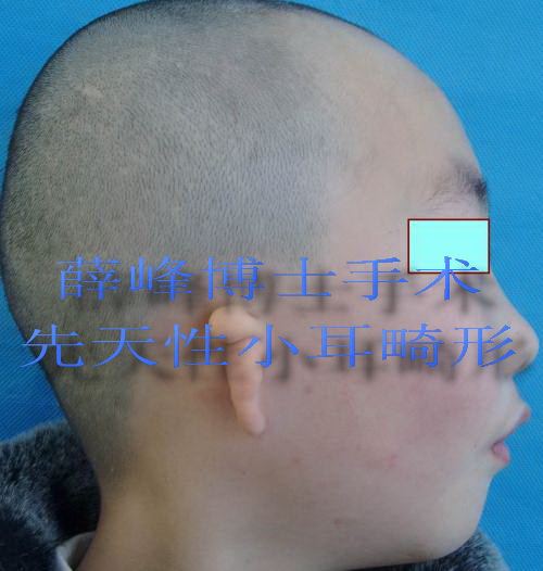 先天性小耳畸形的治疗:外耳再造术
