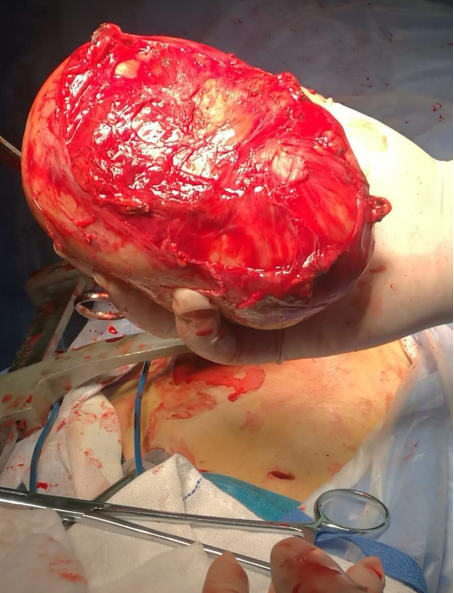 胸腔巨大神经鞘瘤切除术 - 好大夫在线