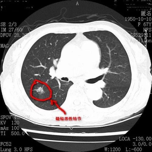肺结节ct片图片图解图片