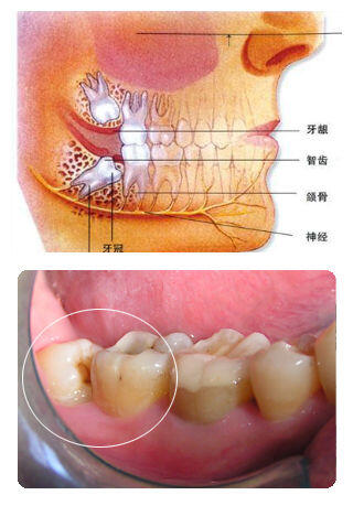智齿一定要拔吗图片