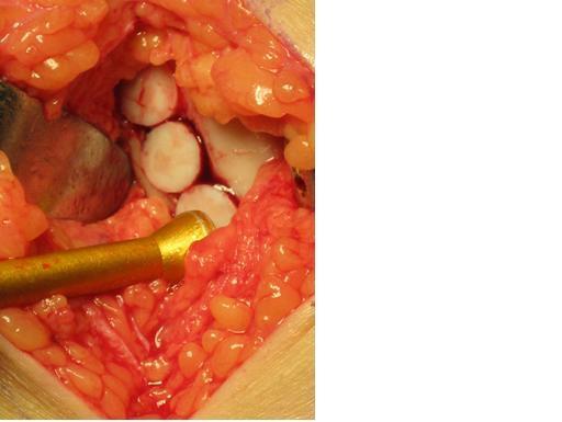 微骨折技術骨軟骨損傷的軟骨置換技術骨軟骨缺損的同種異體骨軟骨移植